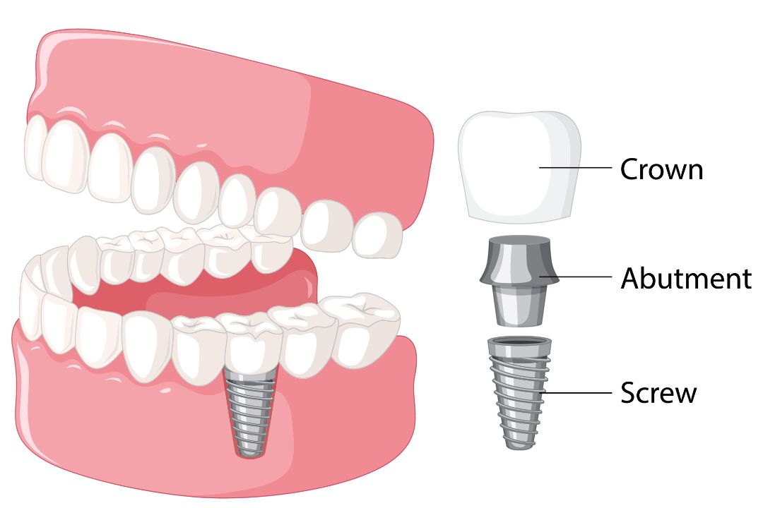 Dental implant near me showing the crown, abutment, and implant screw securely placed in the jawbone